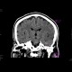 Brain ischemia, MCA, day 1: CT - Computed tomography